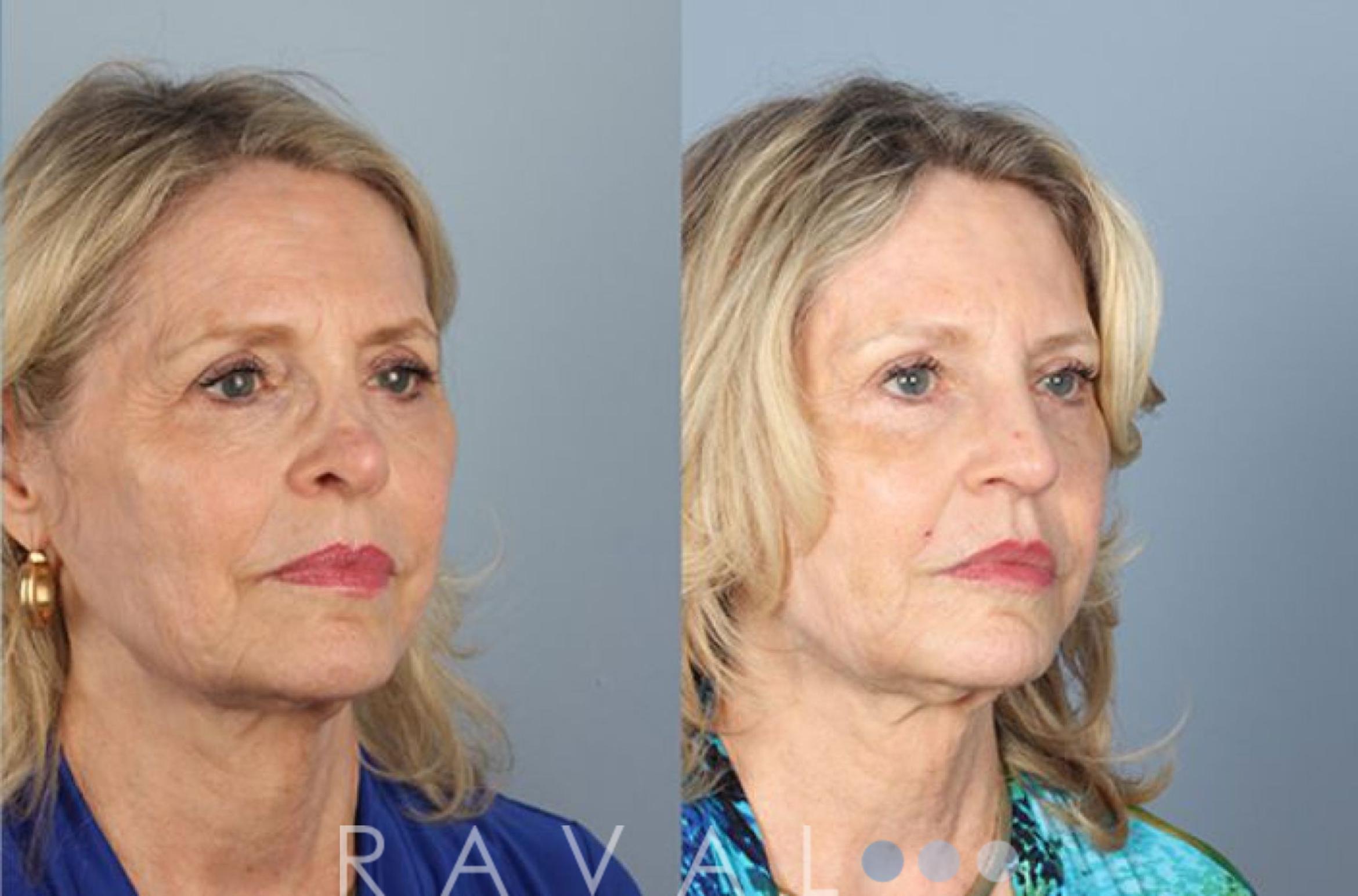 Before & After Revision Rhinoplasty Case 1047 View 2 View in Denver, CO