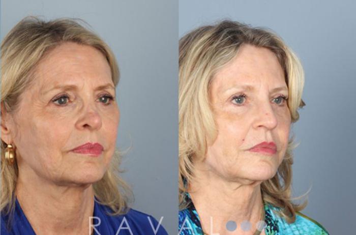 Before & After Revision Rhinoplasty Case 1047 View 2 View in Denver, CO