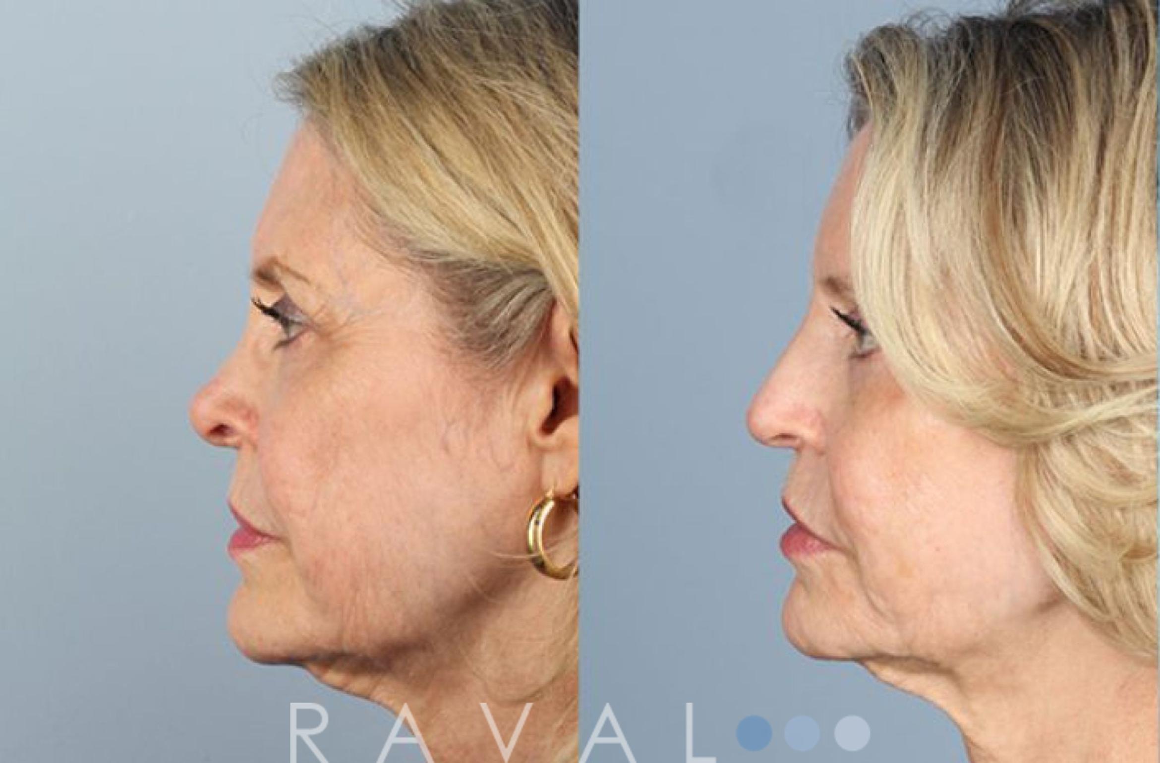 Before & After Revision Rhinoplasty Case 1047 View 3 View in Denver, CO