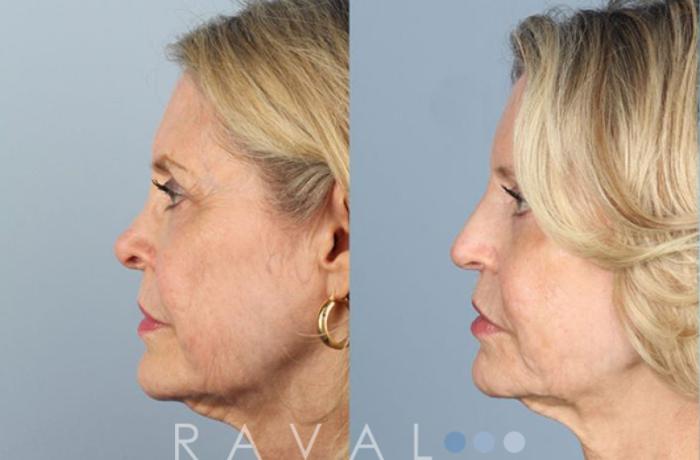 Before & After Revision Rhinoplasty Case 1047 View 3 View in Denver, CO