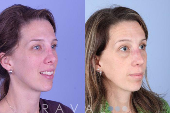 Before & After Revision Rhinoplasty Case 1048 View 1 View in Denver, CO