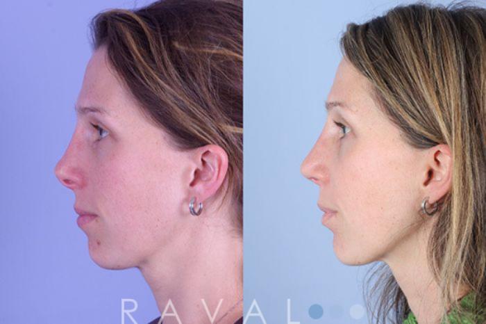 Before & After Revision Rhinoplasty Case 1048 View 2 View in Denver, CO