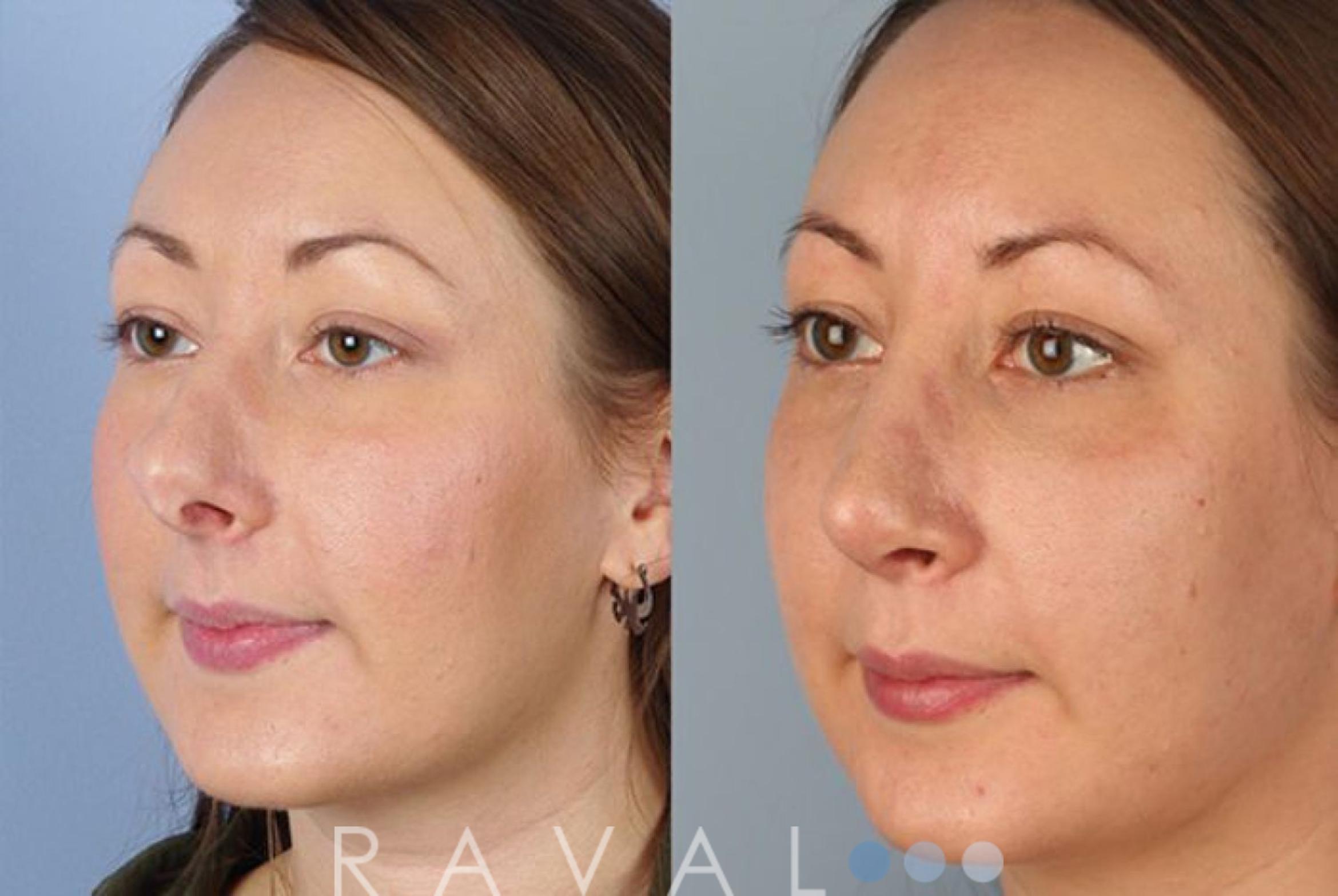 Before & After Revision Rhinoplasty Case 1049 View 2 View in Denver, CO