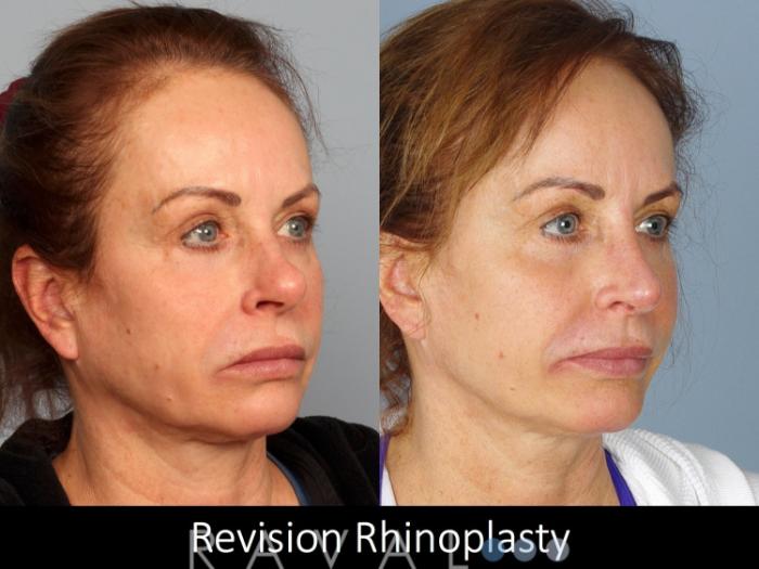 Before & After Revision Rhinoplasty Case 1050 View 1 View in Denver, CO