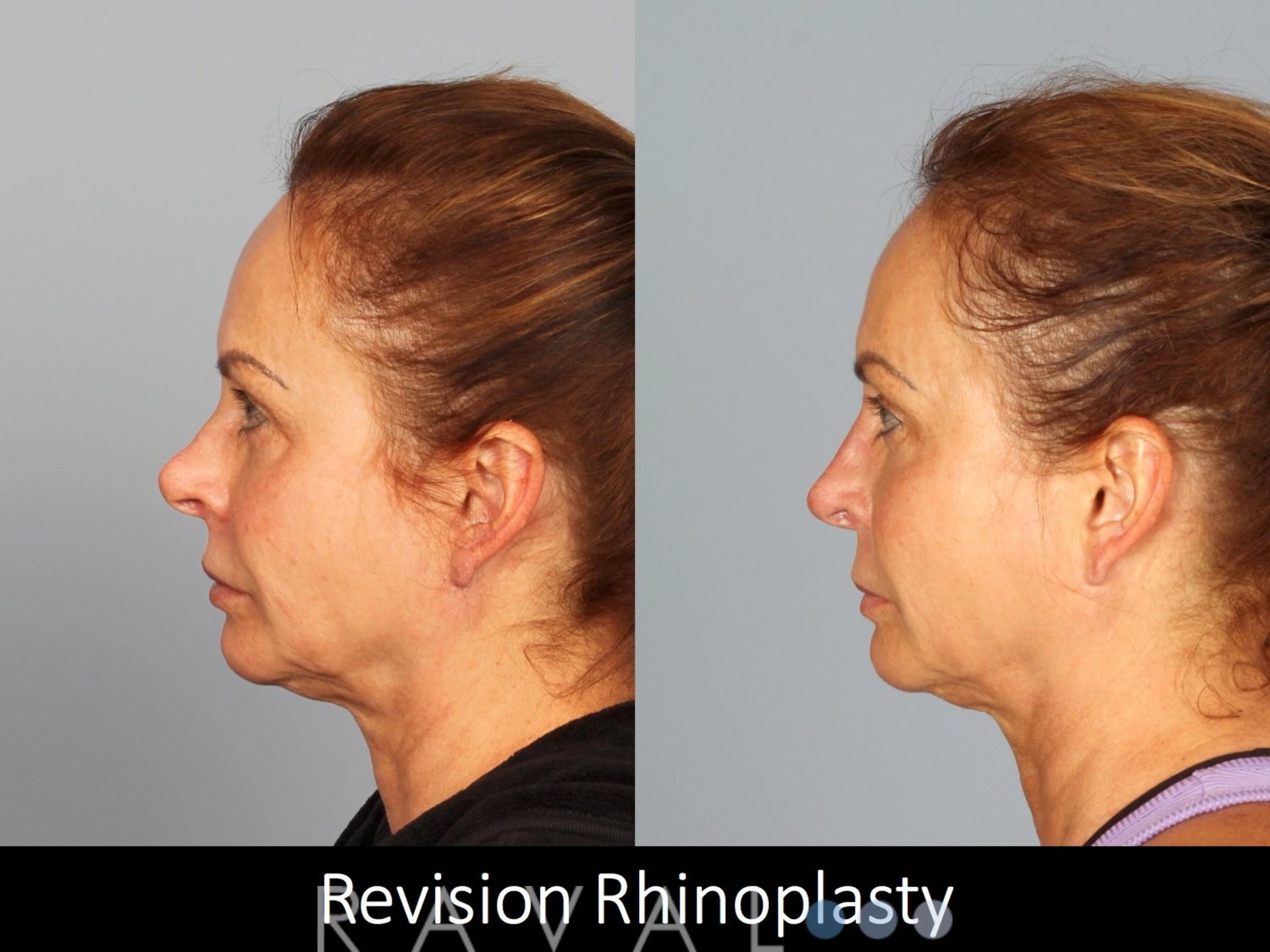 Before & After Revision Rhinoplasty Case 1050 View 2 View in Denver, CO