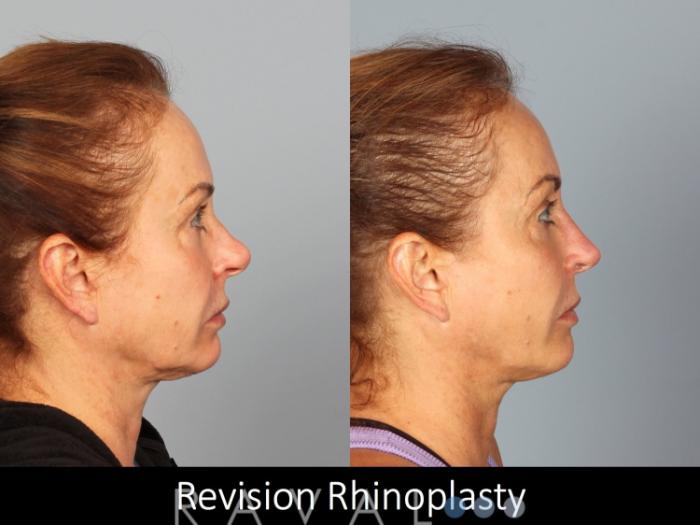 Before & After Revision Rhinoplasty Case 1050 View 3 View in Denver, CO