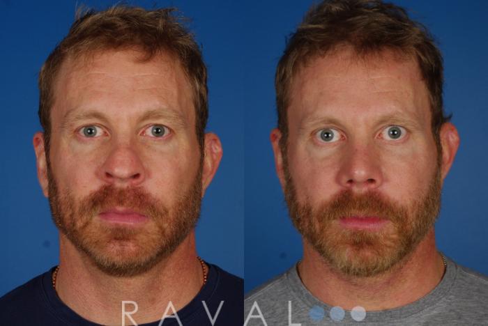 Before & After Revision Rhinoplasty Case 1051 View 1 View in Denver, CO
