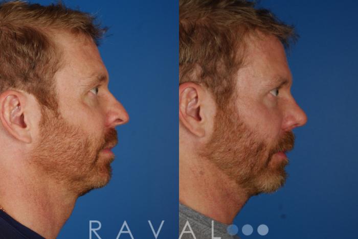Before & After Revision Rhinoplasty Case 1051 View 2 View in Denver, CO