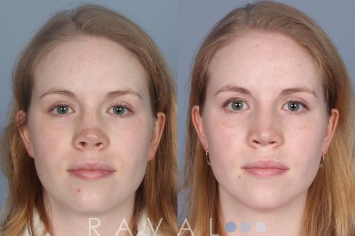 Before & After Revision Rhinoplasty Case 1205 Front View in Denver, CO