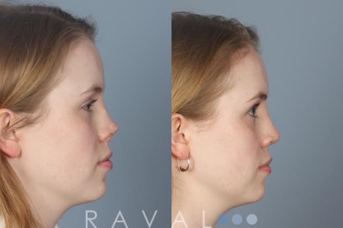 Before & After Revision Rhinoplasty Case 1205 Right Side View in Denver, CO