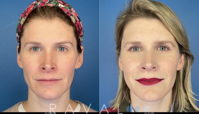 Before & After Revision Rhinoplasty Case 1206 Front View in Denver, CO