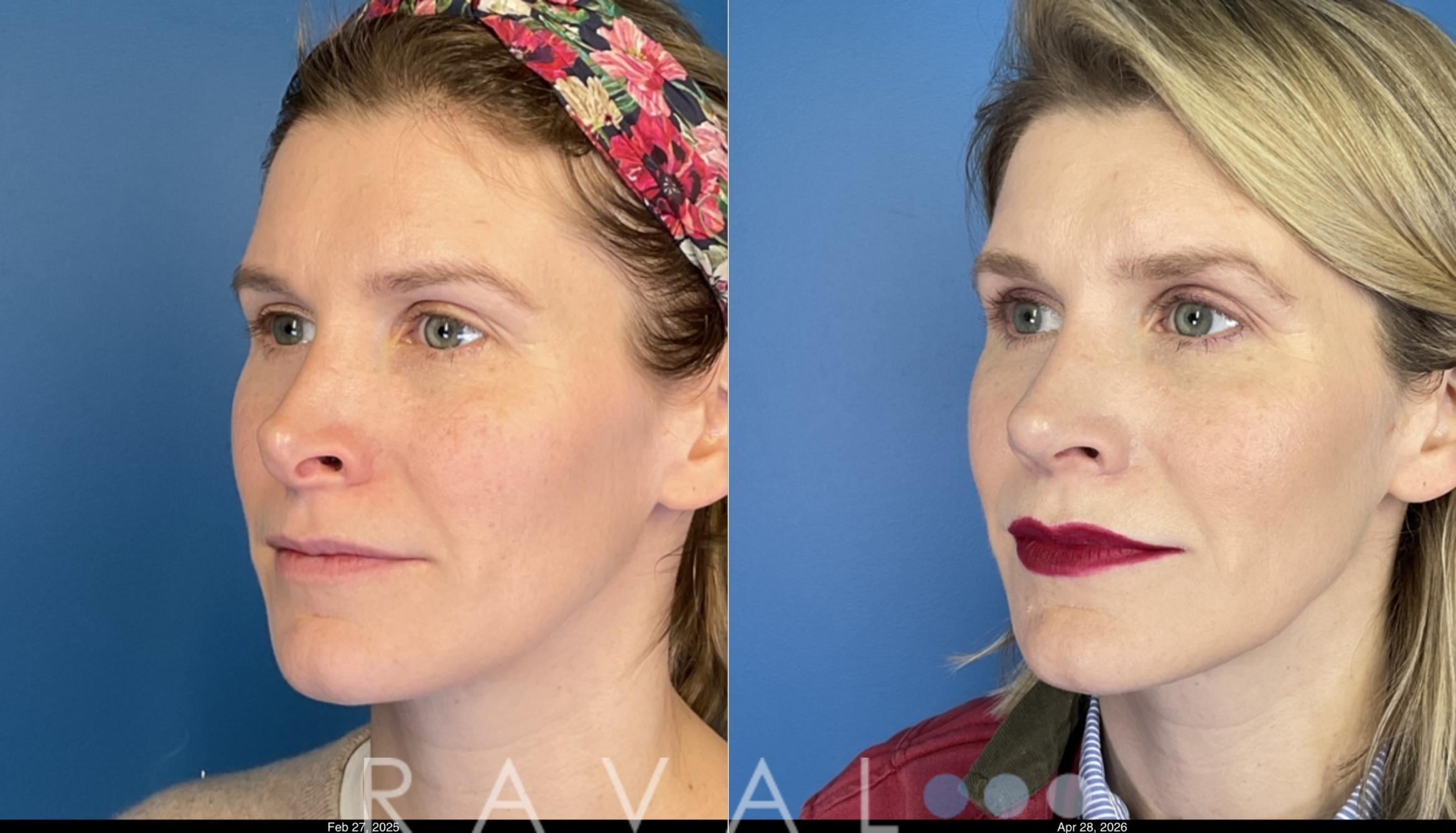 Before & After Revision Rhinoplasty Case 1206 Left Oblique View in Denver, CO