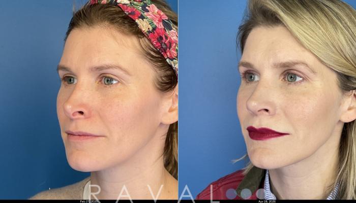 Before & After Revision Rhinoplasty Case 1206 Left Oblique View in Denver, CO