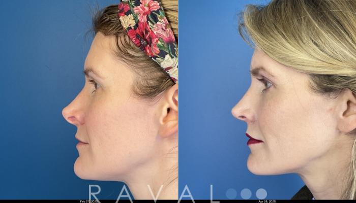 Before & After Revision Rhinoplasty Case 1206 Left Side View in Denver, CO