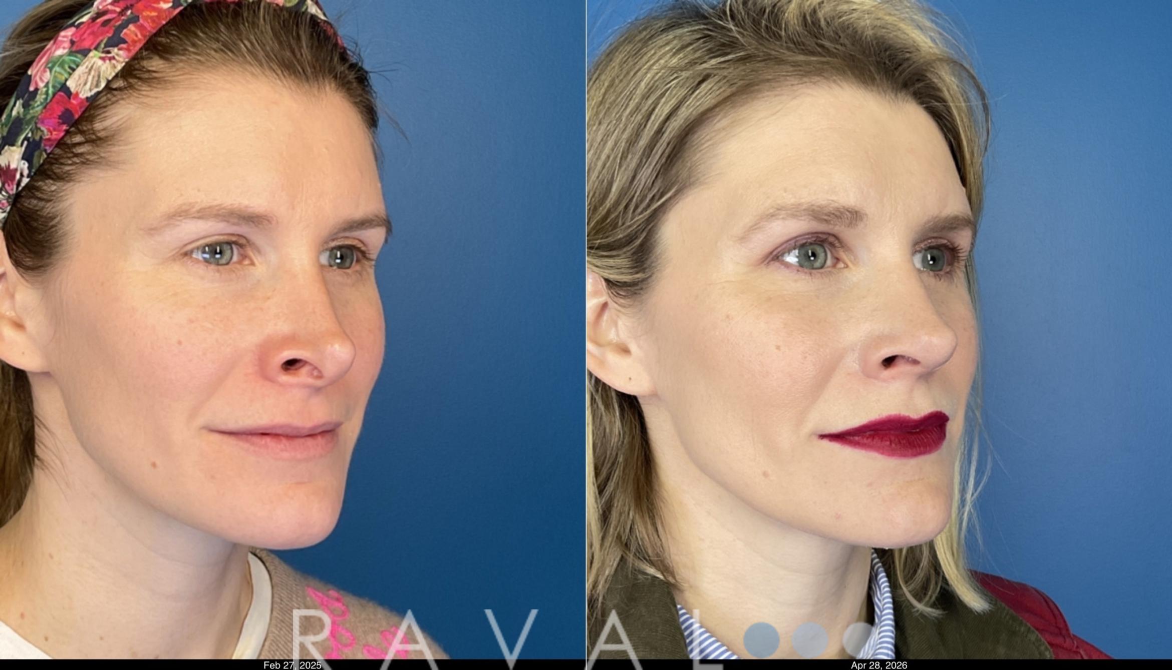 Before & After Revision Rhinoplasty Case 1206 Right Oblique View in Denver, CO