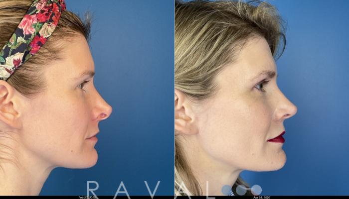 Before & After Revision Rhinoplasty Case 1206 Right Side View in Denver, CO