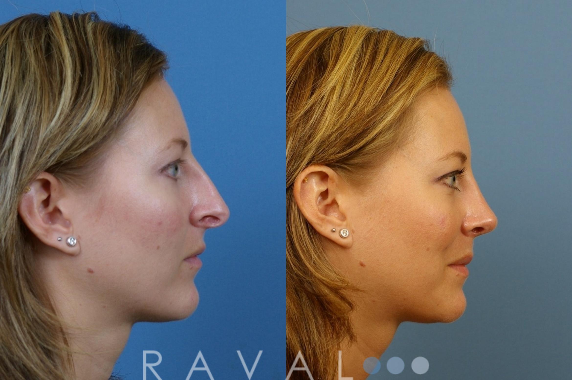 Before & After Rhinoplasty Case 1001 View 2 View in Denver, CO