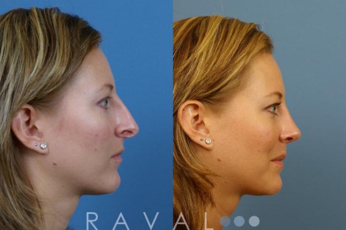 Before & After Rhinoplasty Case 1001 View 2 View in Denver, CO