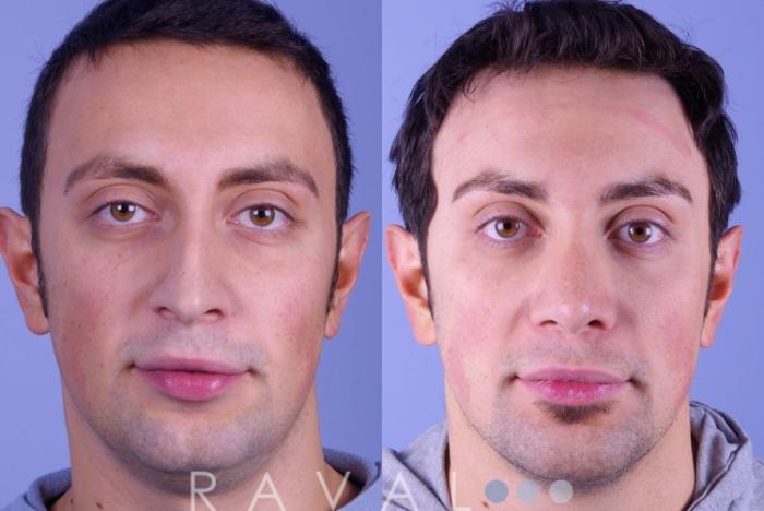 Before & After Rhinoplasty Case 1003 View 1 View in Denver, CO