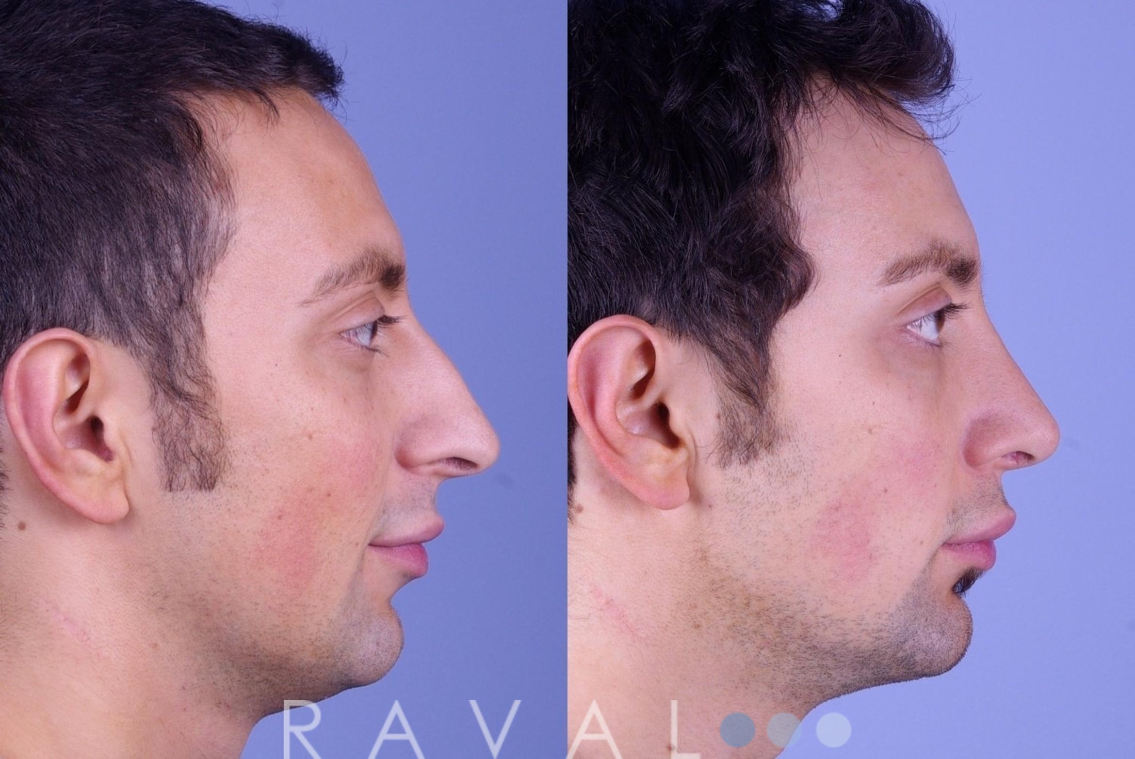 Before & After Rhinoplasty Case 1003 View 2 View in Denver, CO