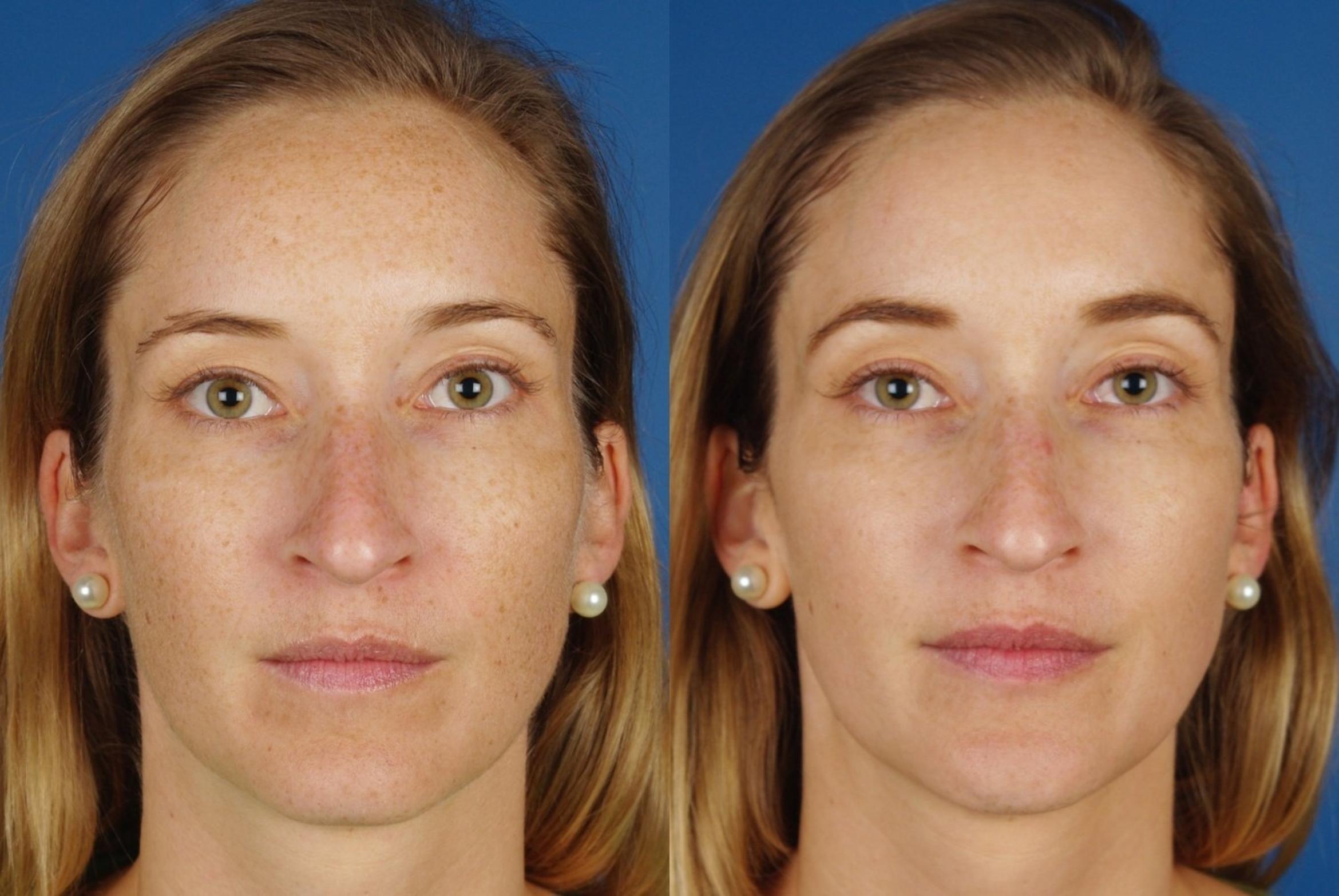 Before & After Rhinoplasty Case 1005 View 1 View in Denver, CO