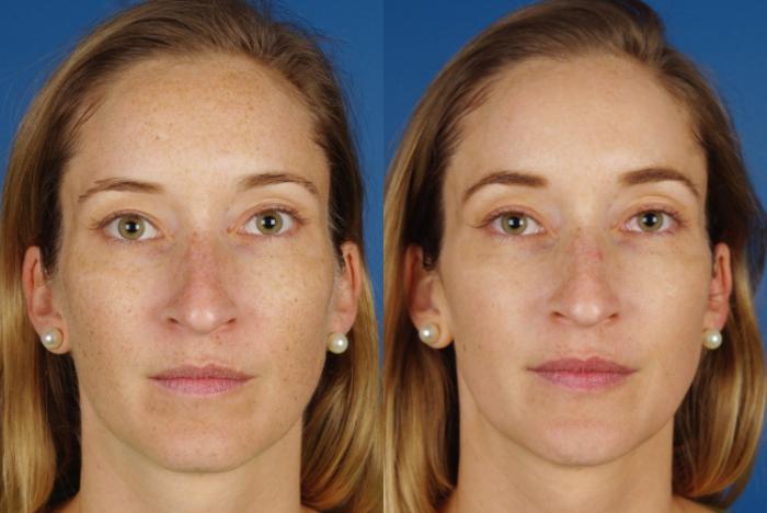 Before & After Rhinoplasty Case 1005 View 1 View in Denver, CO