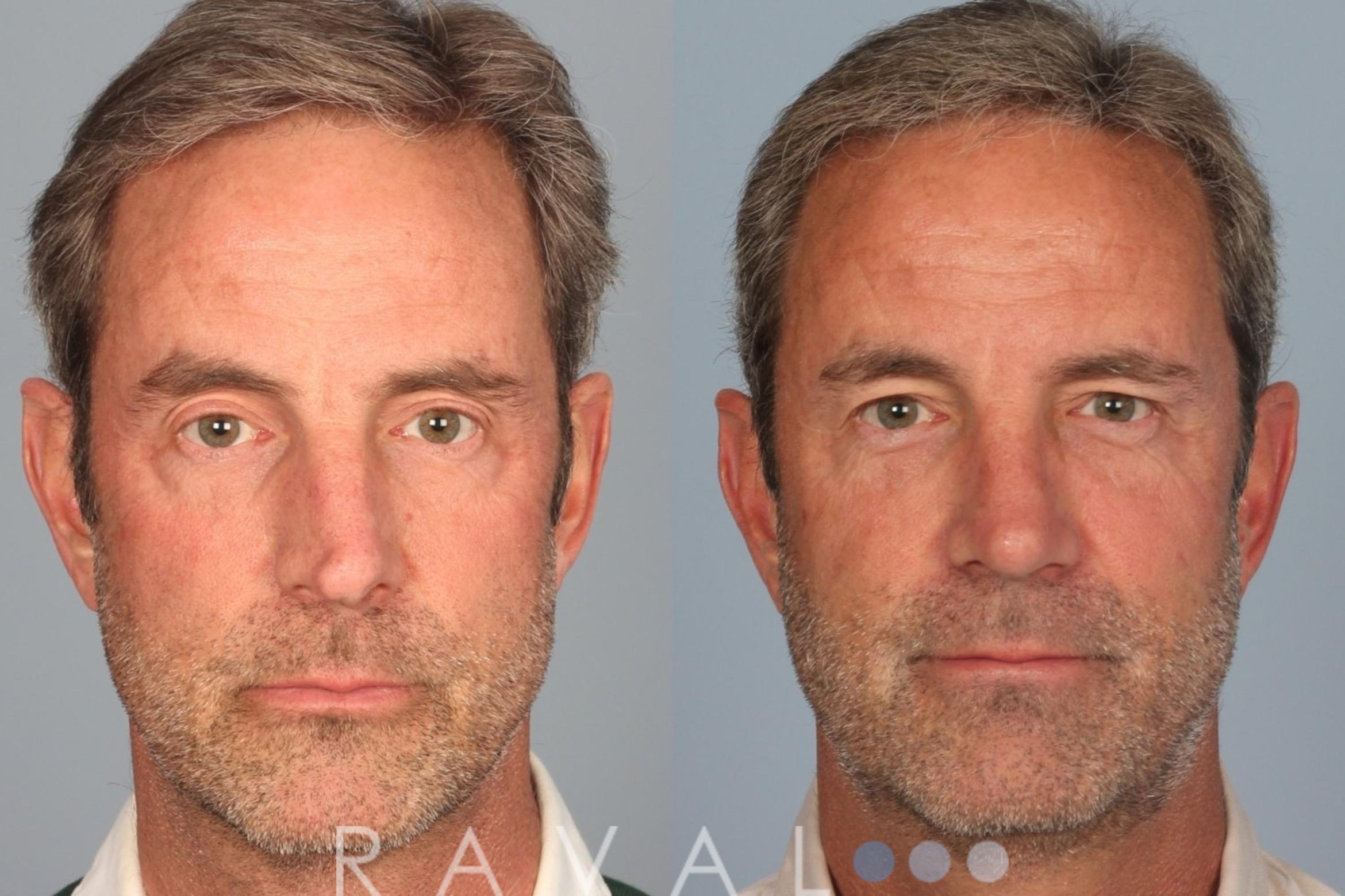 Before & After Rhinoplasty Case 1006 View 1 View in Denver, CO
