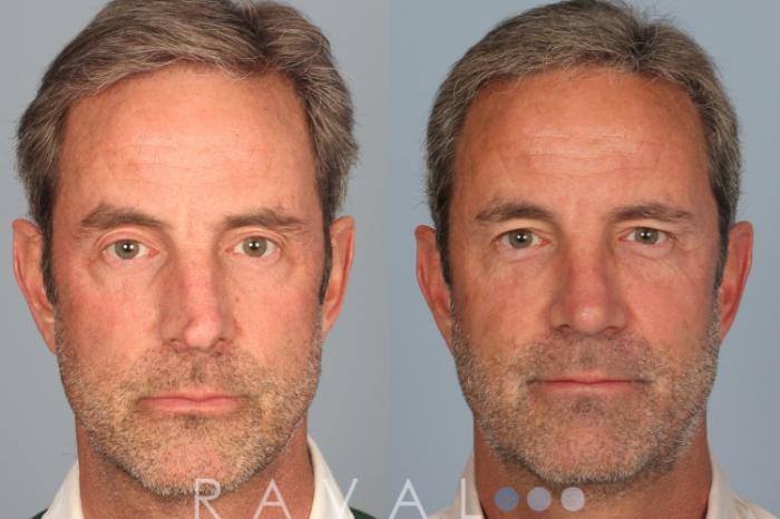 Before & After Rhinoplasty Case 1006 View 1 View in Denver, CO