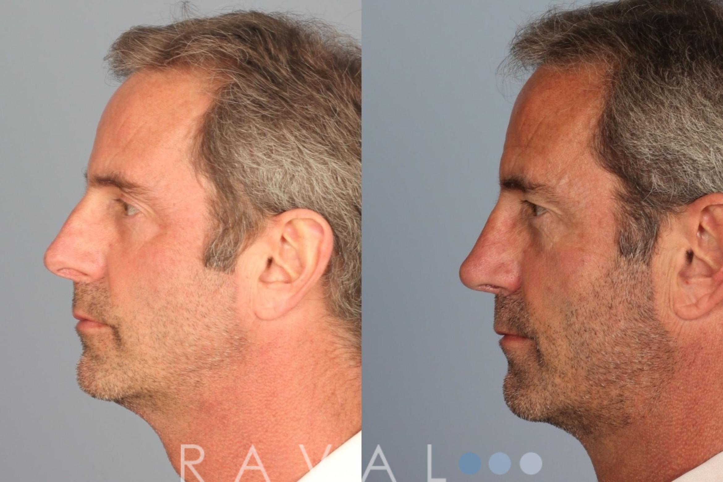 Before & After Rhinoplasty Case 1006 View 2 View in Denver, CO