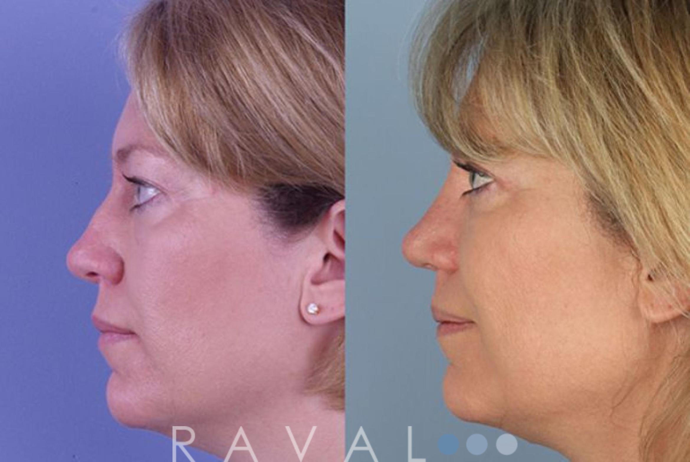 Before & After Rhinoplasty Case 1008 View 1 View in Denver, CO
