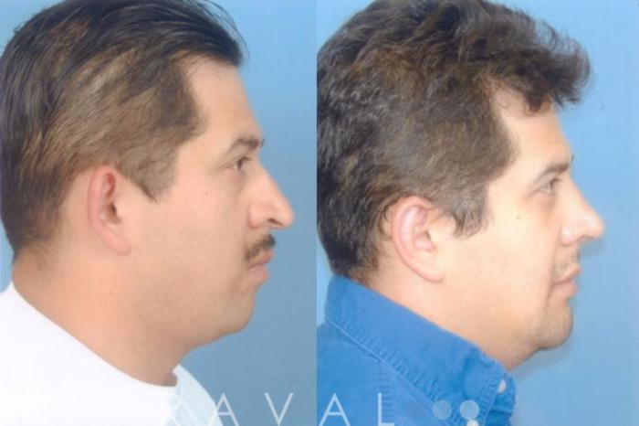 Before & After Rhinoplasty Case 1009 View 2 View in Denver, CO
