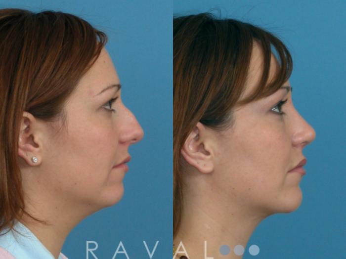 Before & After Rhinoplasty Case 1011 View 1 View in Denver, CO