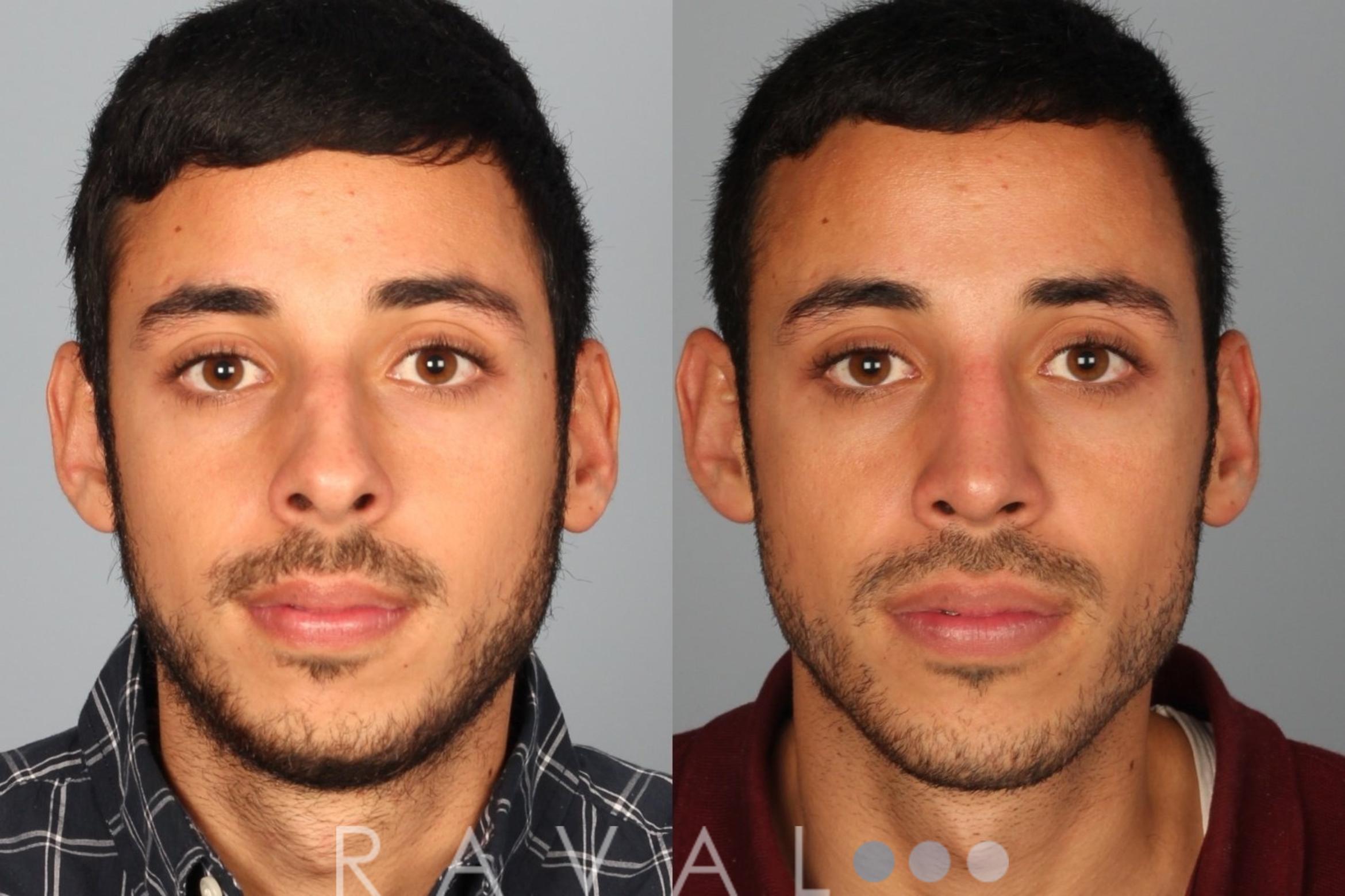 Before & After Rhinoplasty Case 1012 View 1 View in Denver, CO