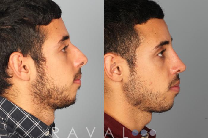 Before & After Rhinoplasty Case 1012 View 2 View in Denver, CO