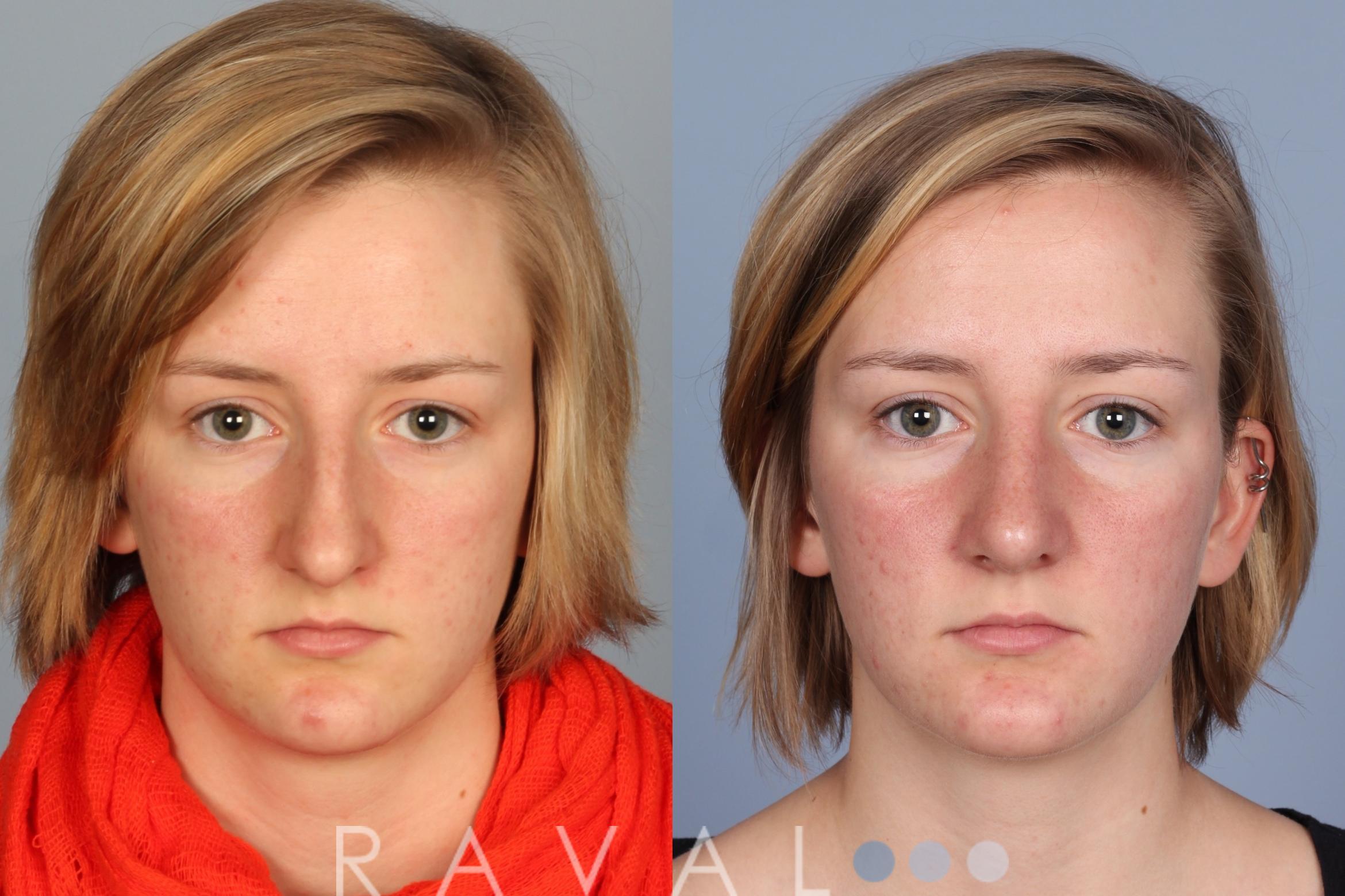 Before & After Rhinoplasty Case 1013 View 1 View in Denver, CO