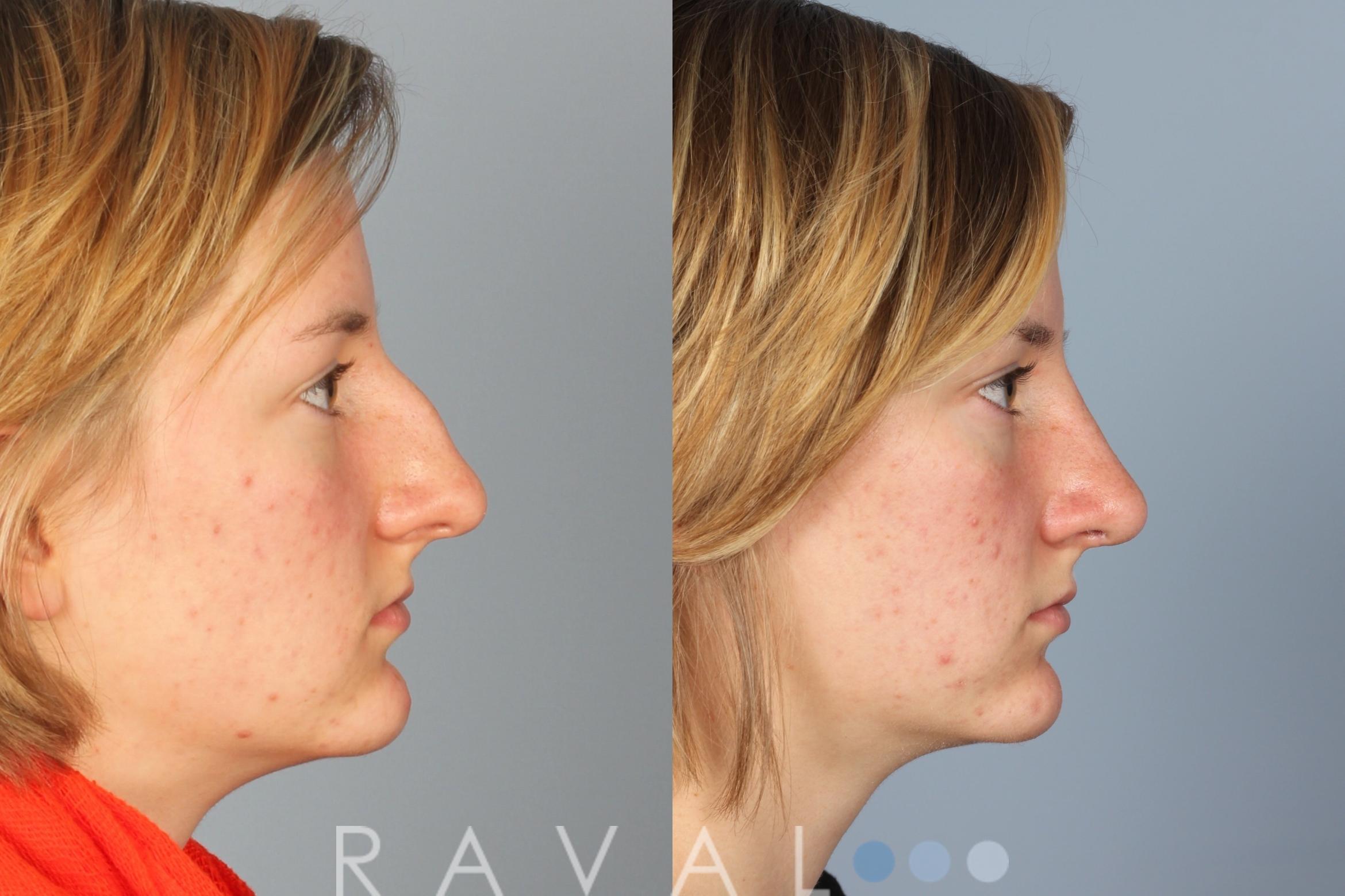 Before & After Rhinoplasty Case 1013 View 2 View in Denver, CO