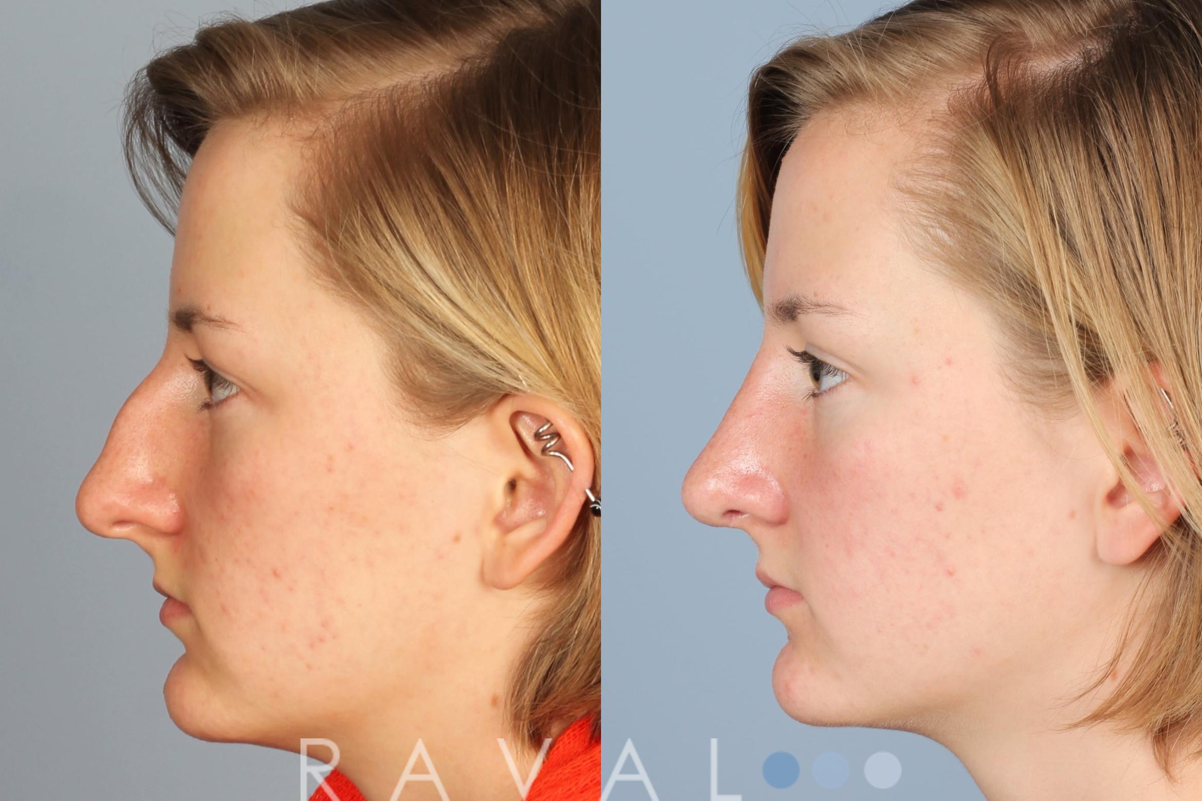 Before & After Rhinoplasty Case 1013 View 3 View in Denver, CO