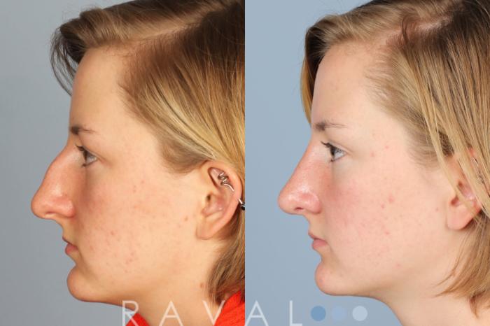 Before & After Rhinoplasty Case 1013 View 3 View in Denver, CO