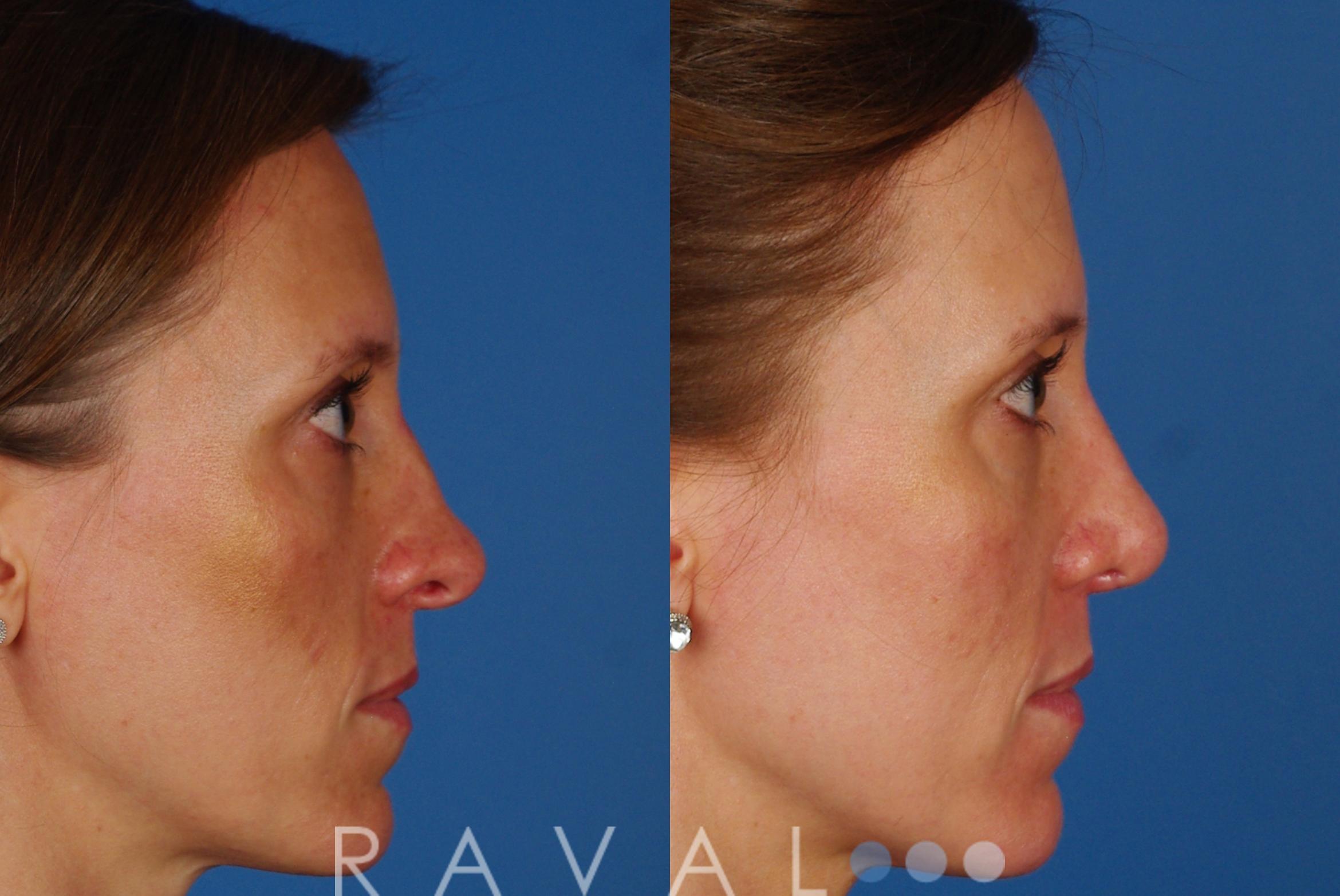 Before & After Rhinoplasty Case 1014 View 2 View in Denver, CO