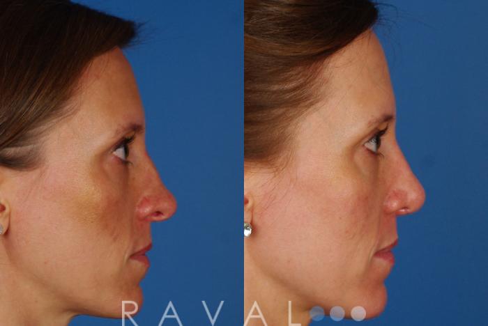 Before & After Rhinoplasty Case 1014 View 2 View in Denver, CO