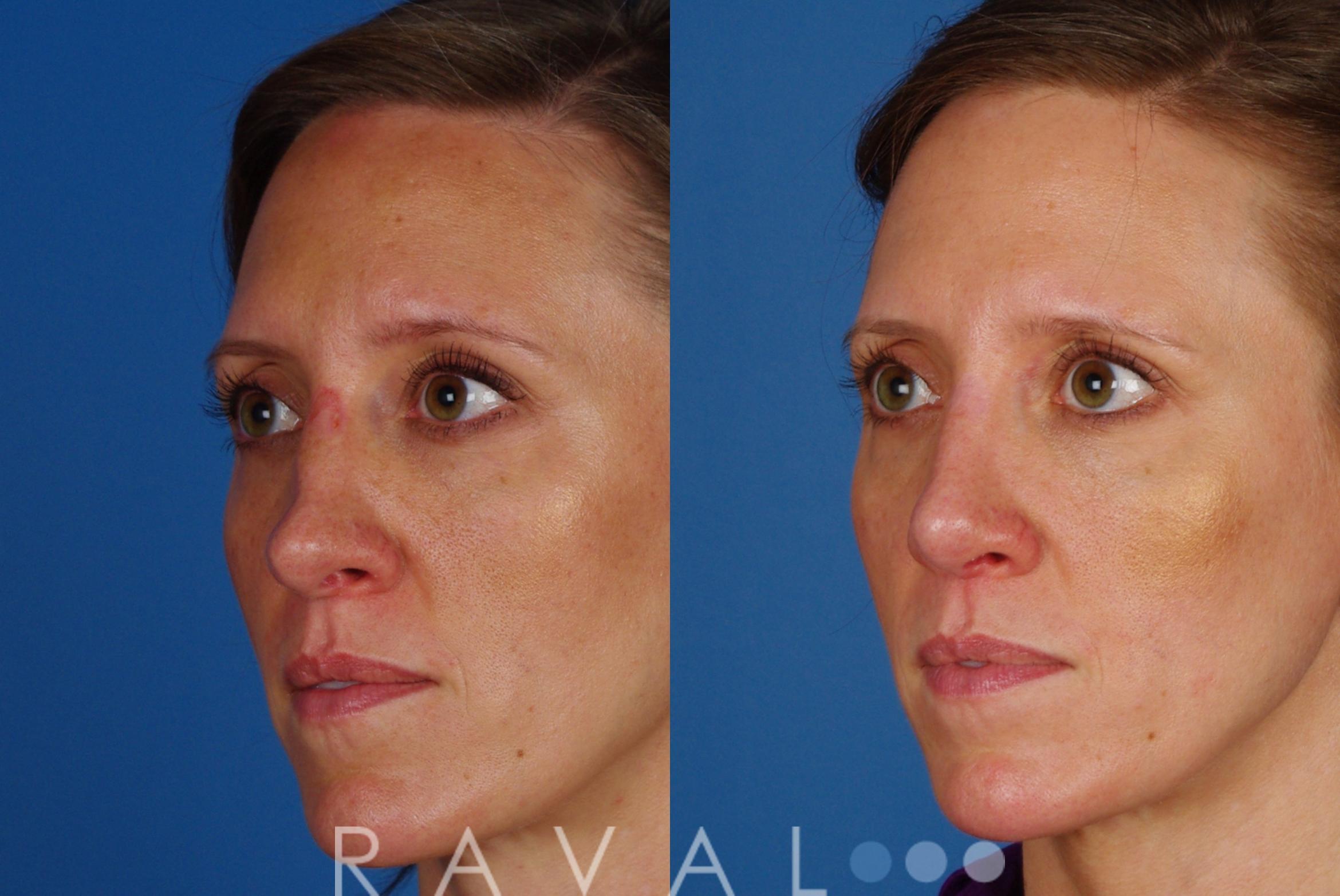 Before & After Rhinoplasty Case 1015 View 1 View in Denver, CO