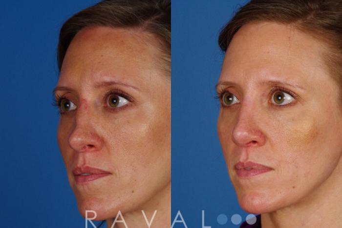Before & After Rhinoplasty Case 1015 View 1 View in Denver, CO