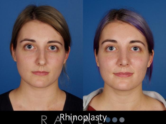 Before & After Rhinoplasty Case 1016 View 1 View in Denver, CO