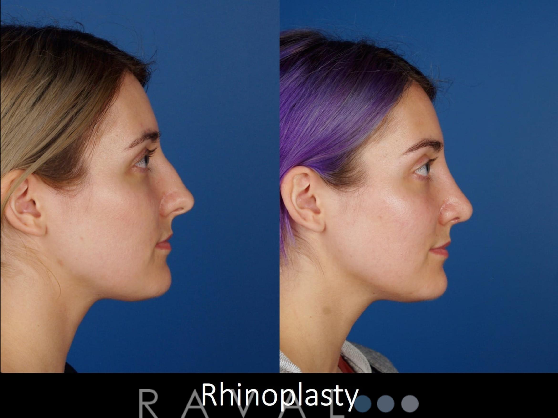 Before & After Rhinoplasty Case 1016 View 2 View in Denver, CO