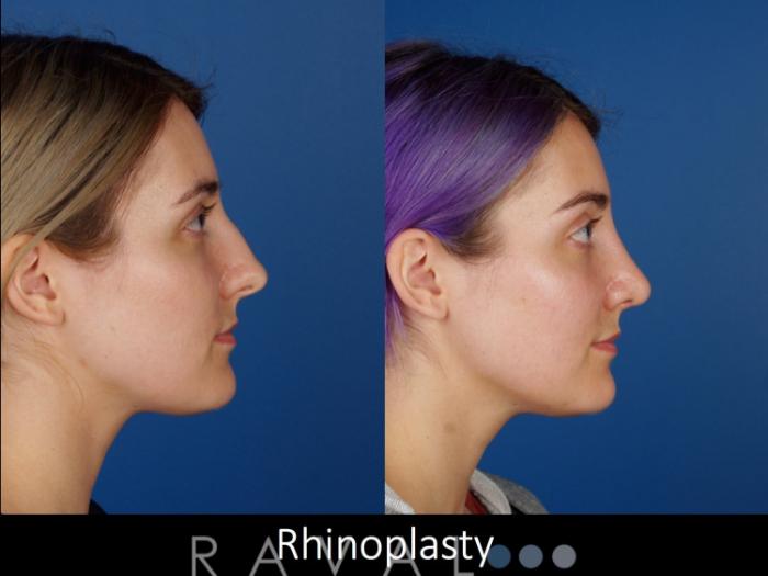 Before & After Rhinoplasty Case 1016 View 2 View in Denver, CO