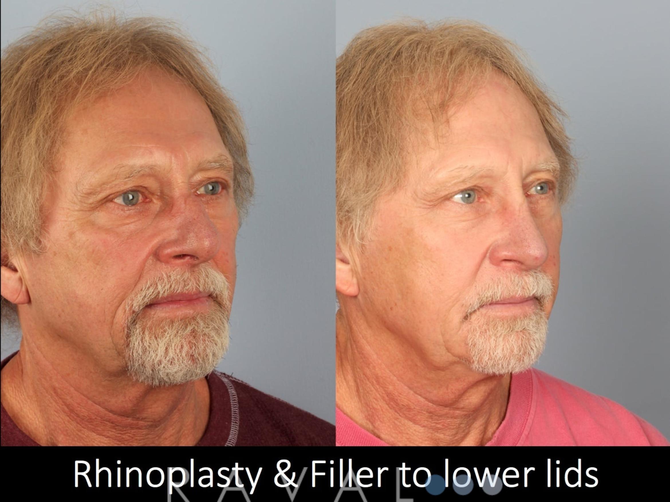 Before & After Rhinoplasty Case 1017 View 1 View in Denver, CO