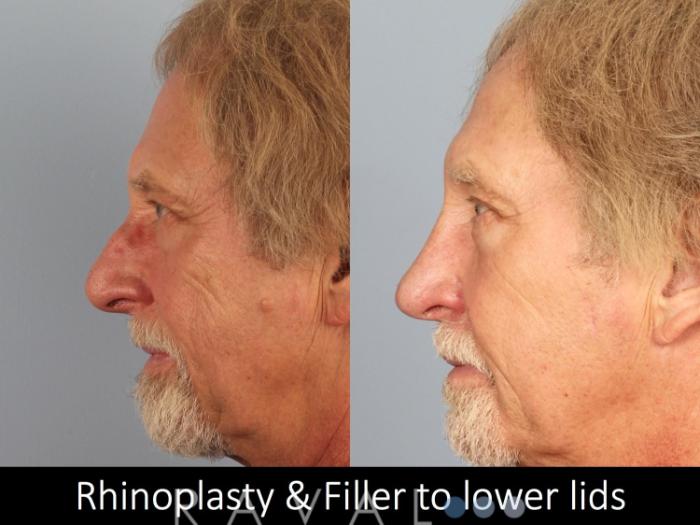 Before & After Rhinoplasty Case 1017 View 2 View in Denver, CO