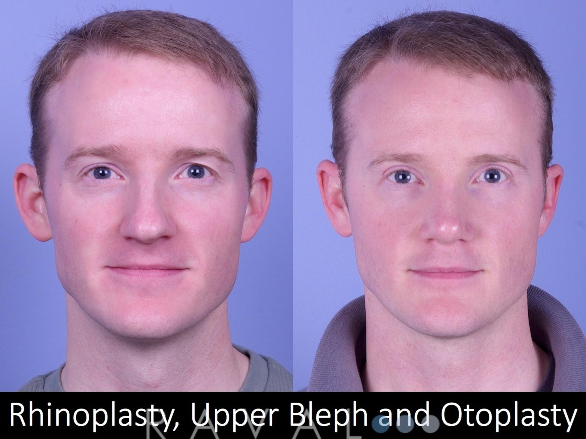 Before & After Rhinoplasty Case 1018 View 1 View in Denver, CO