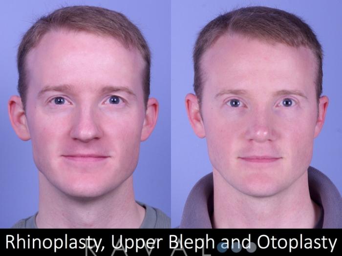 Before & After Rhinoplasty Case 1018 View 1 View in Denver, CO