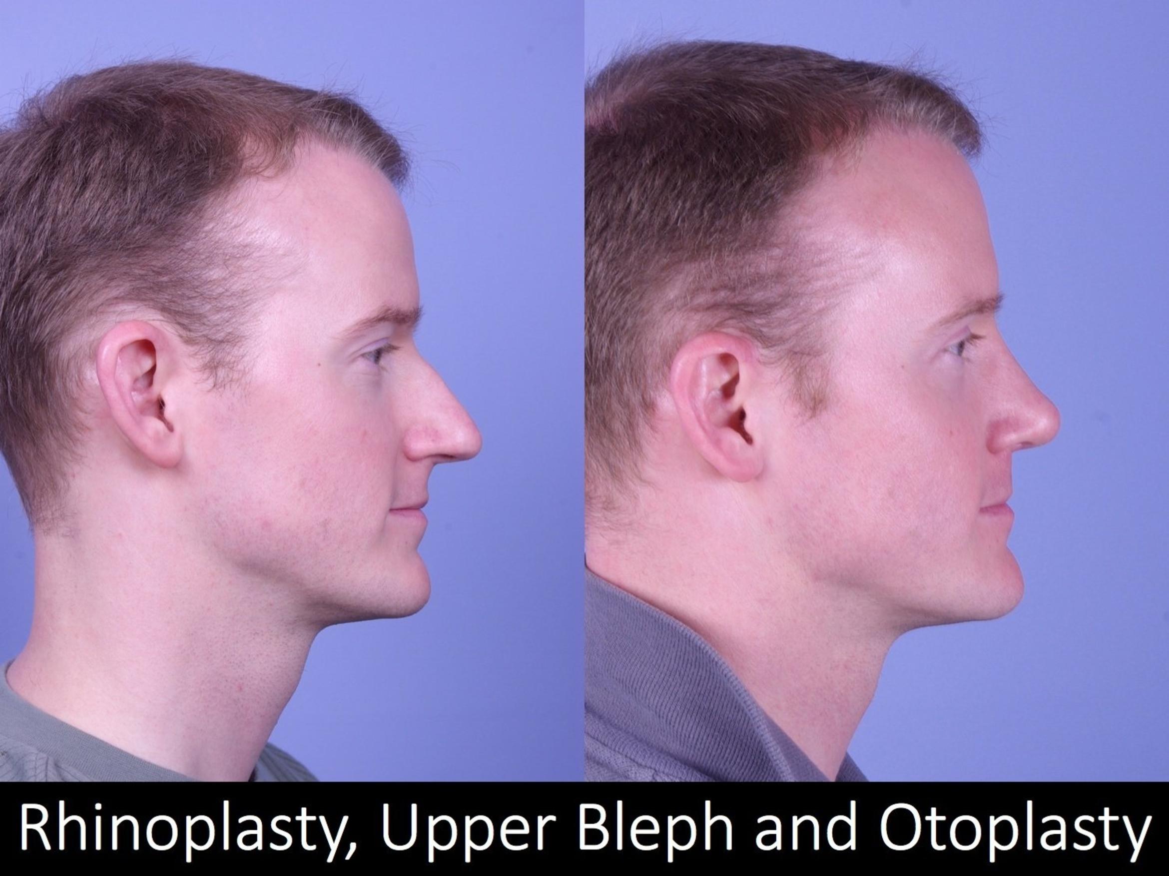 Before & After Rhinoplasty Case 1018 View 2 View in Denver, CO